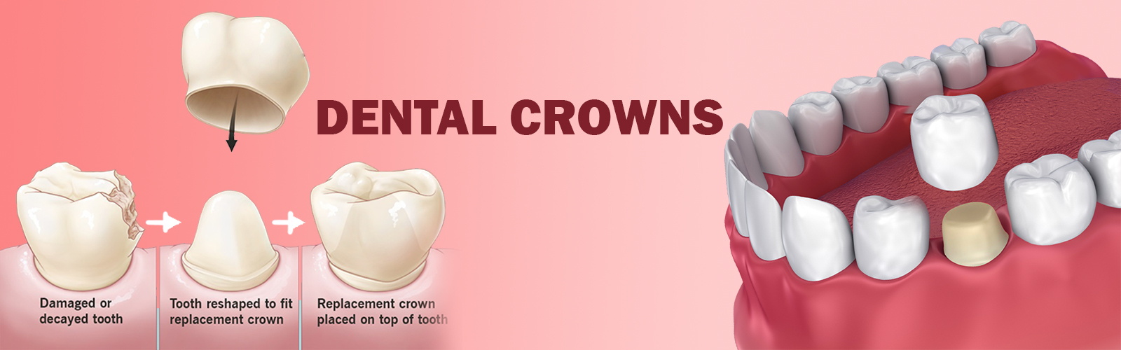 Dental_crowns_BANNER_1626685760_BANNER_1645702615.jpg