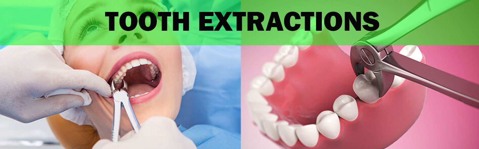 Tooth_extractions_BANNER_1626686327_BANNER_1645705283.jpg