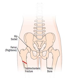 Hip Fracture