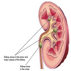 Kidney stones