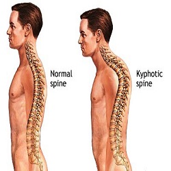 Kyphosis