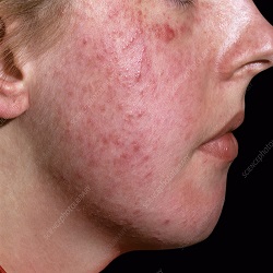 Rosacea