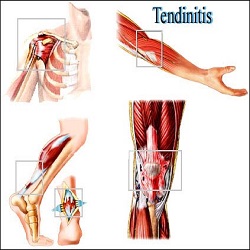 Tendinitis