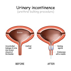 Urinary Incontinence