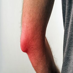 Bursitis