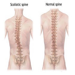 Scoliosis 